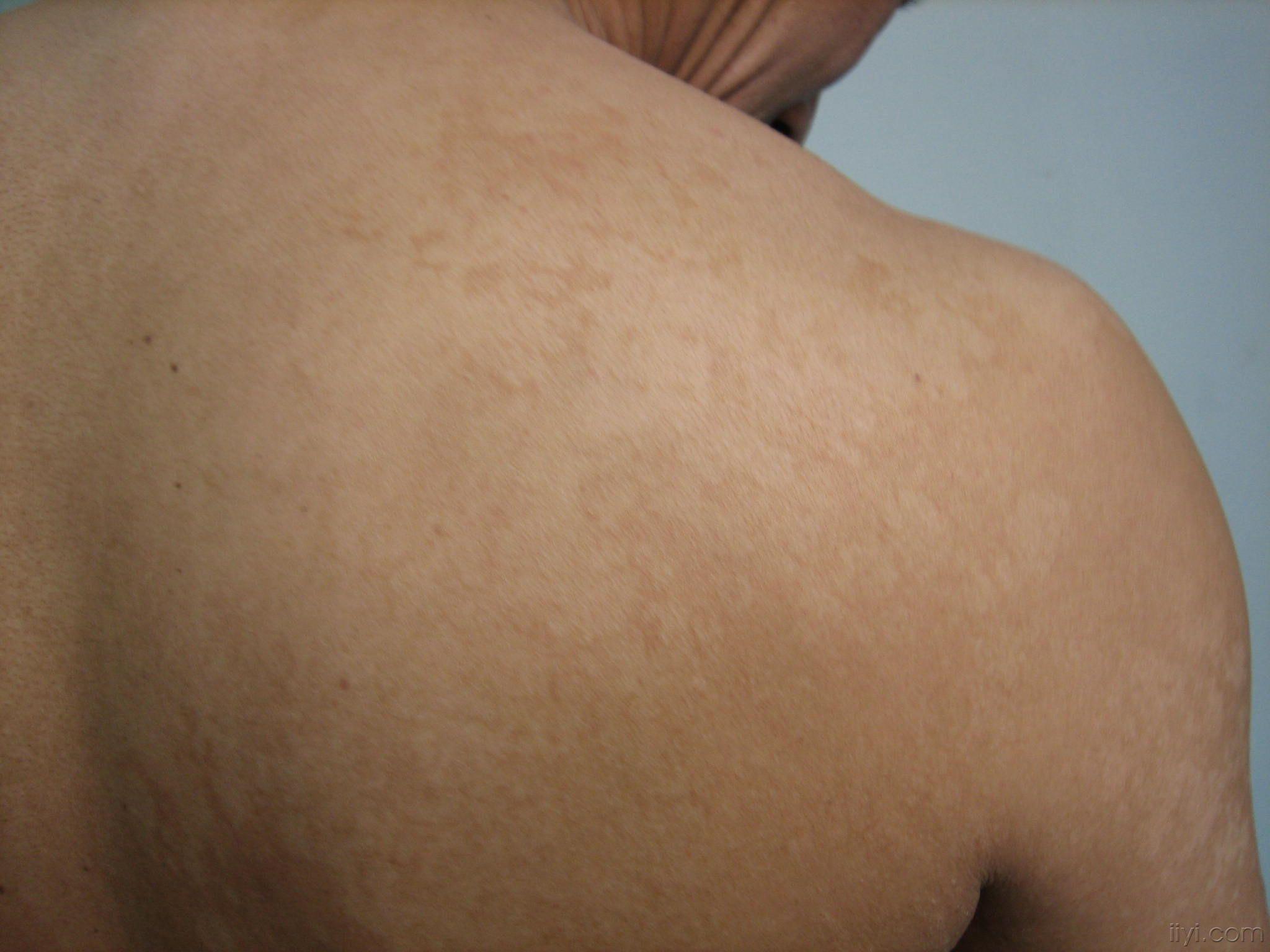 看看漂亮的花斑癣