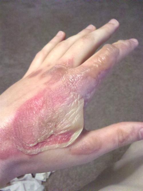 烧伤做清创手术后多久可以好