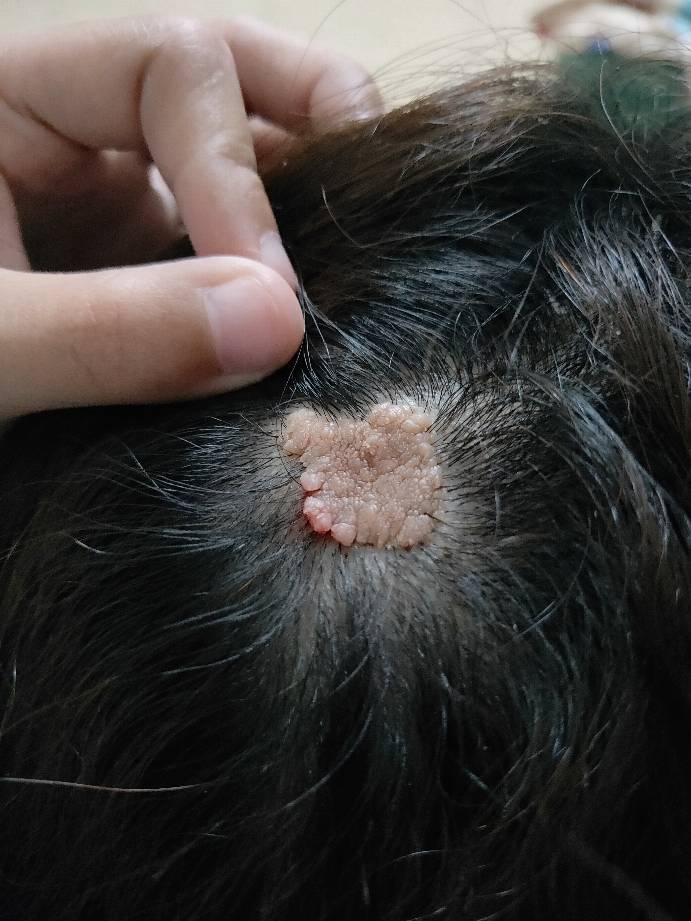 你好,我一个好姐妹头顶上这东西叫什么 有得治吗?请看相片.