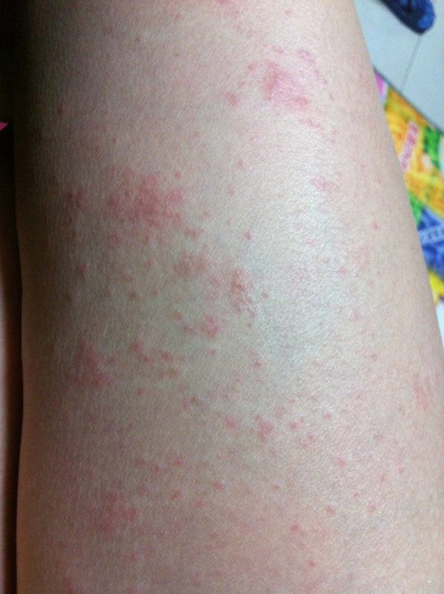 大人湿疹症状图片_有来医生