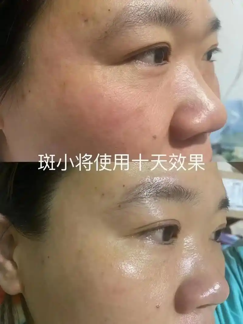 敏感肌皮肤 斑小将使用十天效果 斑小将一个月 斑小将前后对比 - 抖音