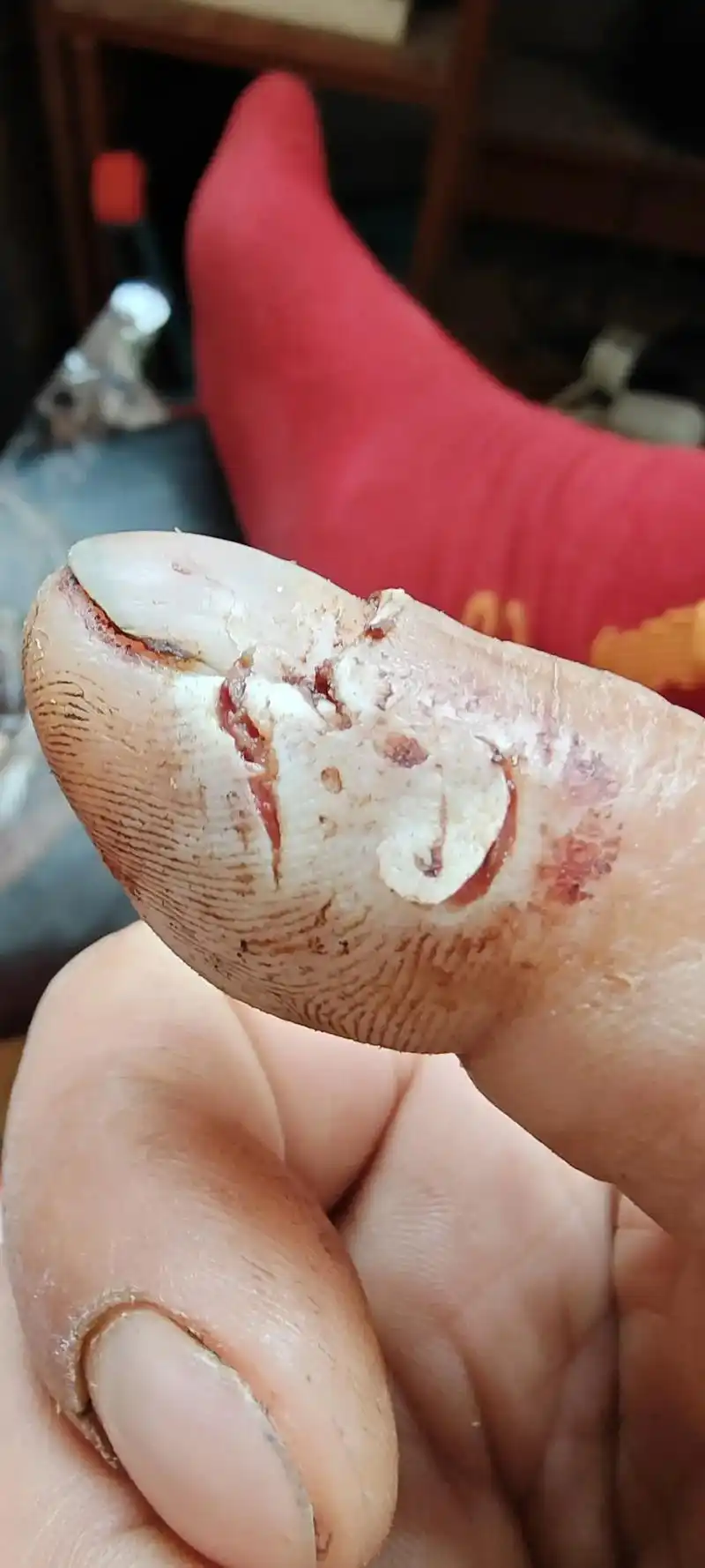 手指受伤了一不小心