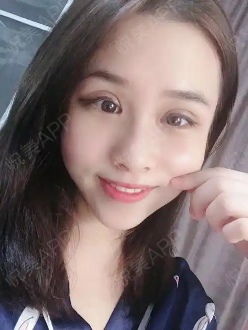 眼综合整形术后7天_全切双眼皮术后7天_眼型矫正术后7天_眼综合术后7