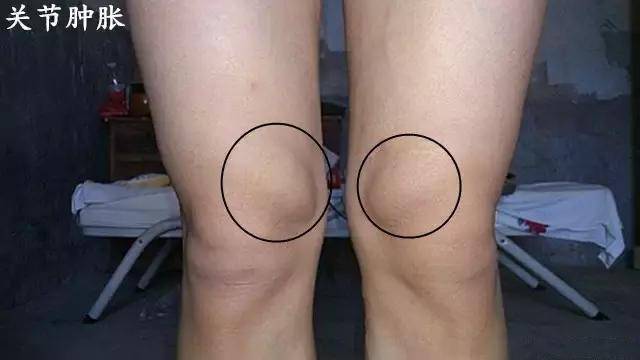 十个膝盖疼九个有滑膜炎农村一株草15天逼走疼痛已验证