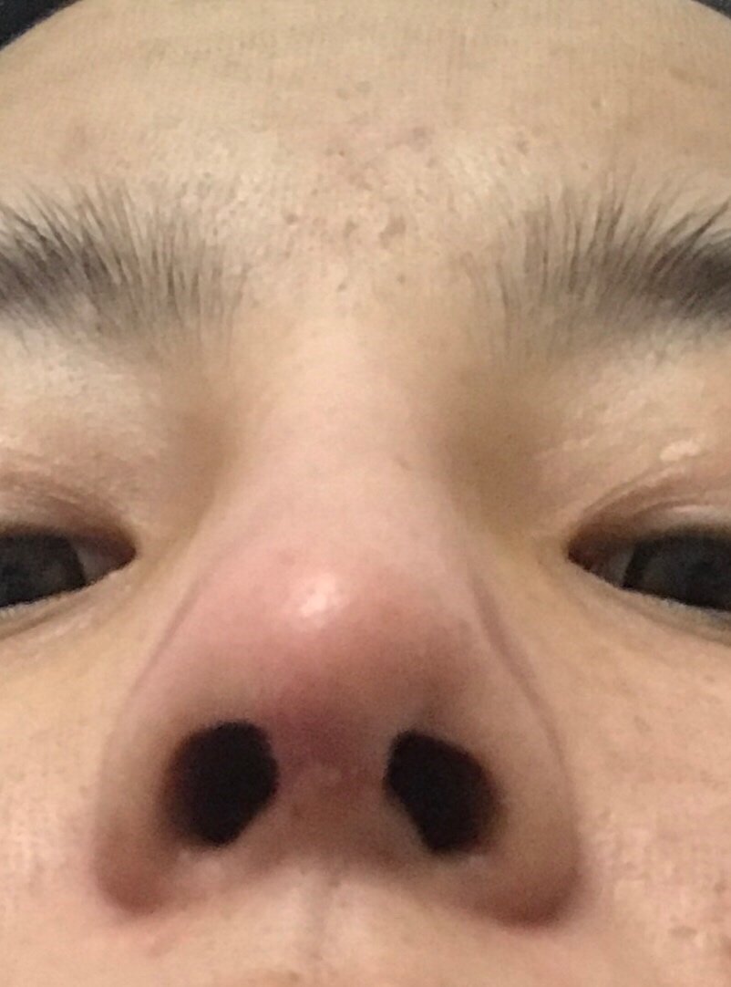 请问我现在是不是鼻头增生了