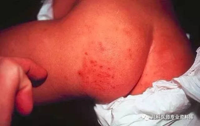 手足处表现为数个到数十个斑丘疹或疱疹,多表现为不痛,不痒,不结痂,不