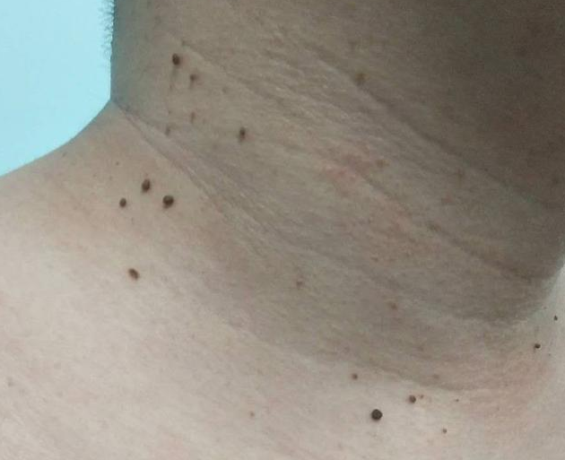 丝状疣反复发作怎么办_疣_介绍_治疗方式_日常注意事项 - 好大夫在线