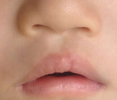 唇腭裂的辨别及修复方法有哪些