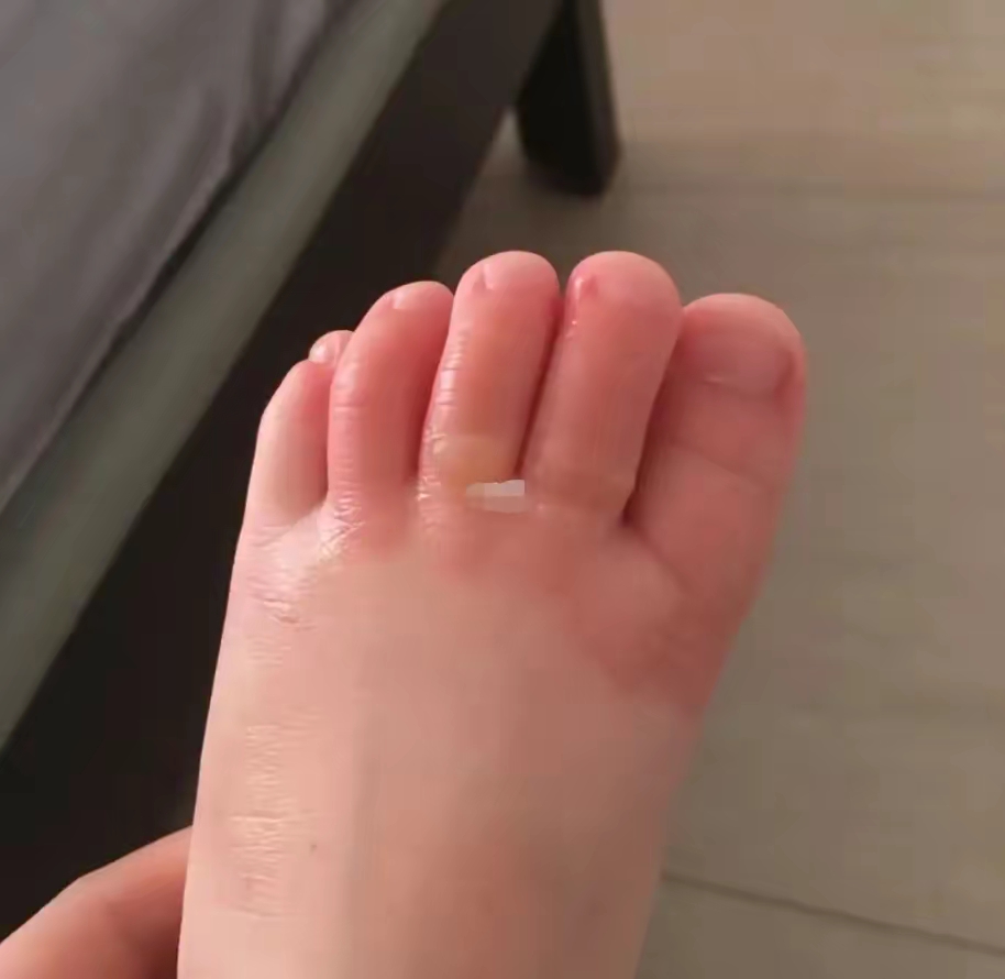 生活中,孩子的脚如果不小心被烫伤,不严重的话,可以用冷水冲一下烫伤