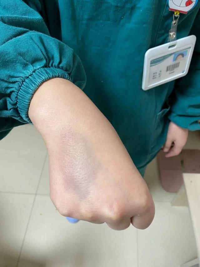 一天连按手消600多次余杭白衣战士的手背布满淤青
