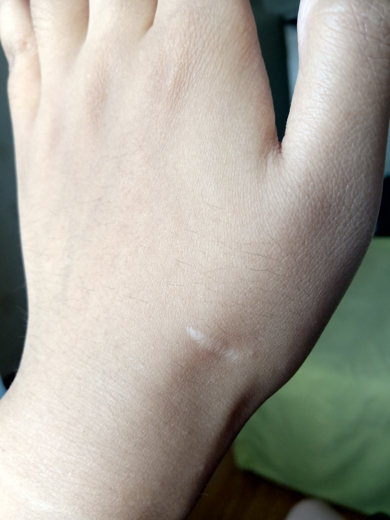 手上这个疤痕难看吗?严重吗?