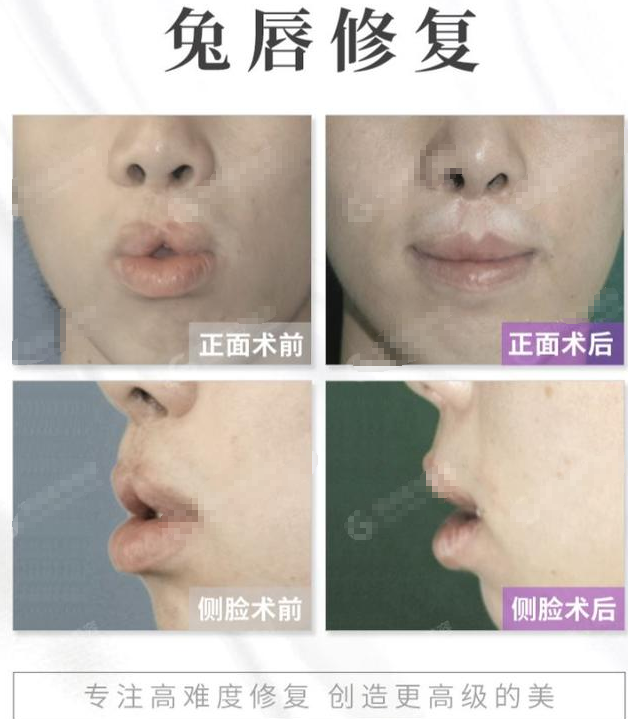 唇腭裂_唇腭裂治疗方式 - 好大夫在线