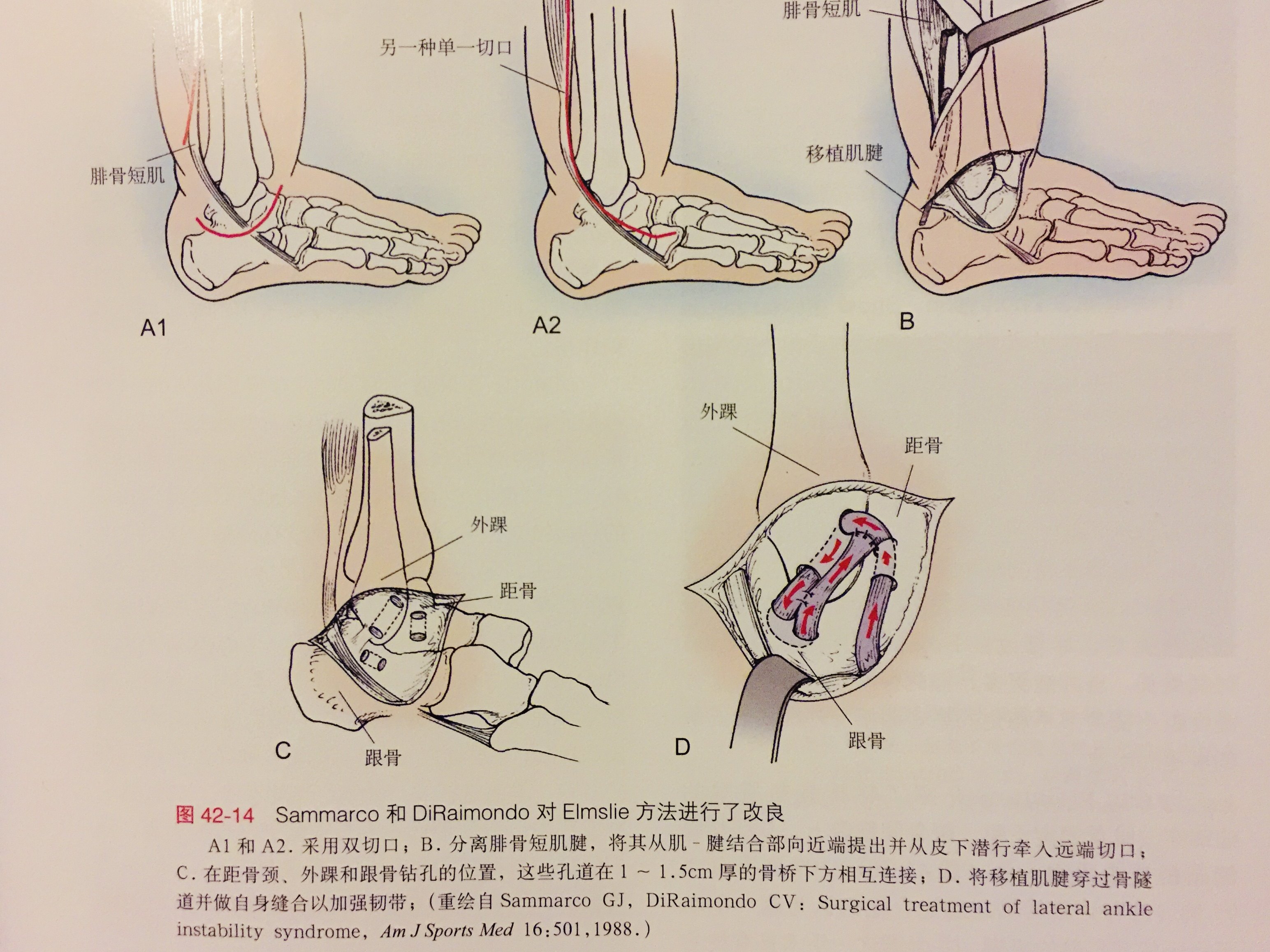 2)eyring术式:将腓骨短肌腱的前半穿过腓骨隧道缝合于距跟骨间韧带,以