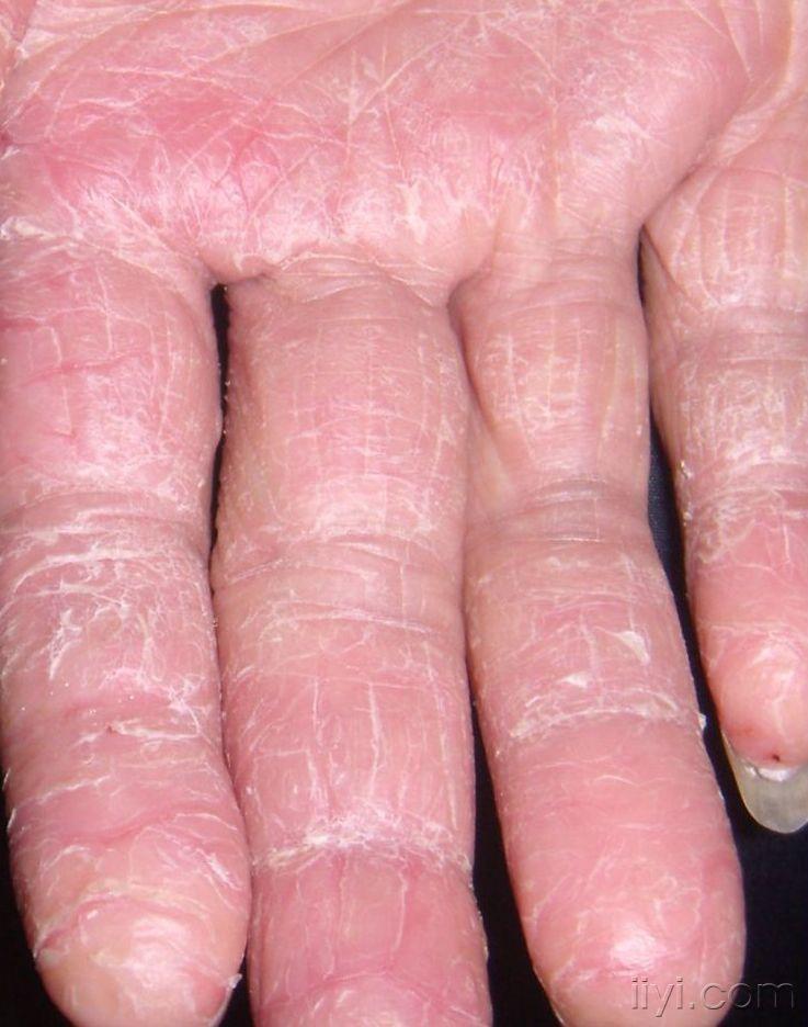 手皲裂.jpg