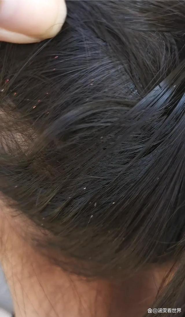 海南:女孩头上爬满了虱子让人头皮发麻,妈妈改嫁奶奶不管