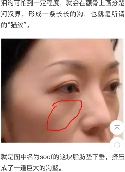 很长很长的泪沟叫猫纹印第安纹怎么解决