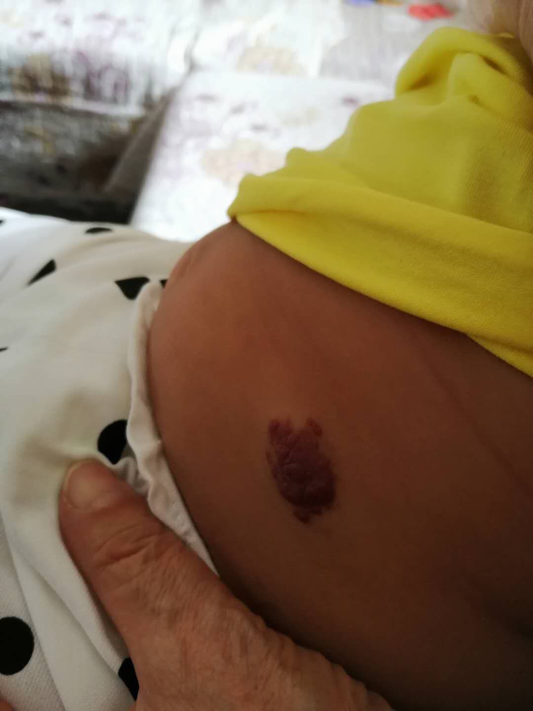 婴幼儿血管瘤会自行消退吗