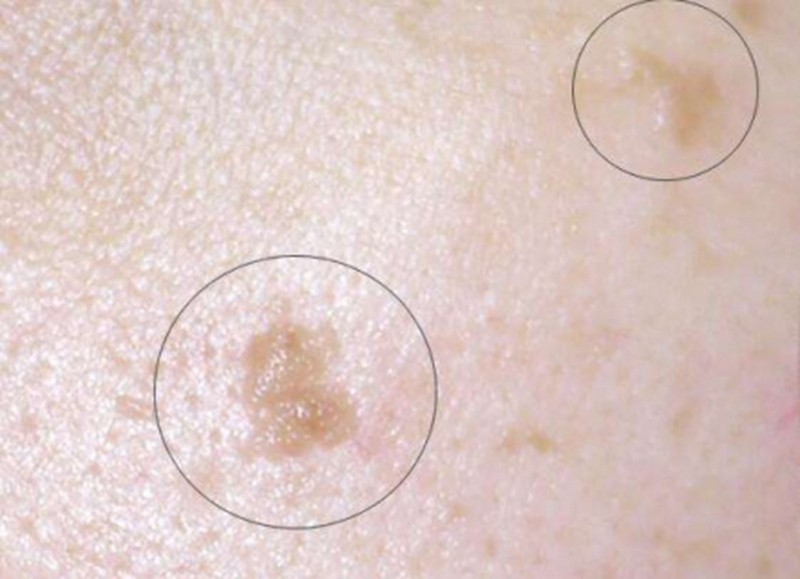 脚部扁平疣症状图片