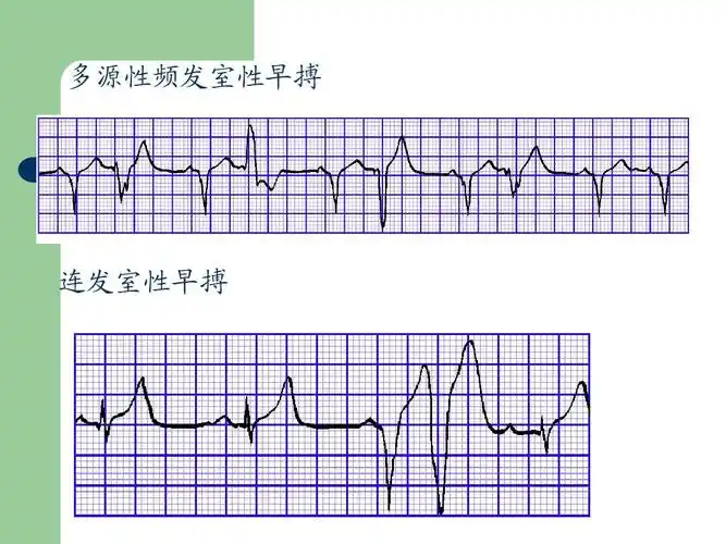常见异常心电图