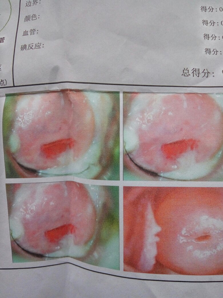 宫颈糜烂,如图所示,请问吃什么药可以治疗.