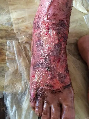 20天,肉芽正在生长