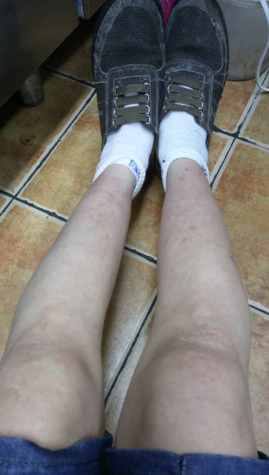 上阶梯很费劲,全身无力,特别是下肢无力,小腿肌肉萎缩,请问医生是啥病