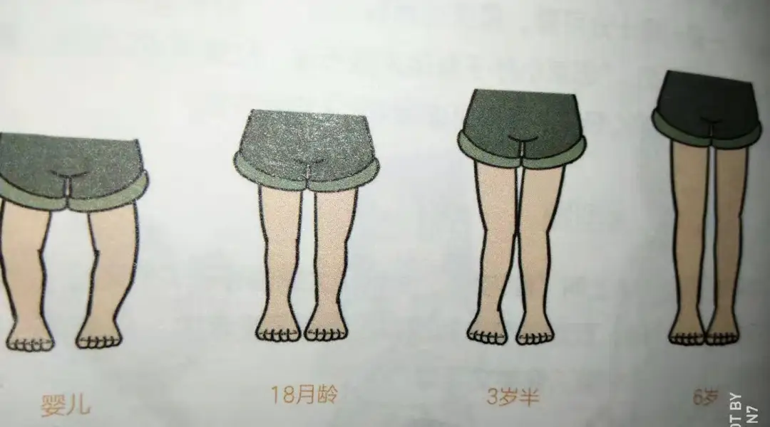 事实上,很多宝宝在一岁前出现胫骨弯曲,2岁前都有o型腿