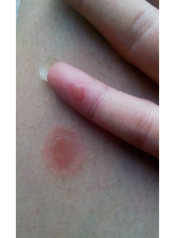 梅毒前期小红点图片 (13)