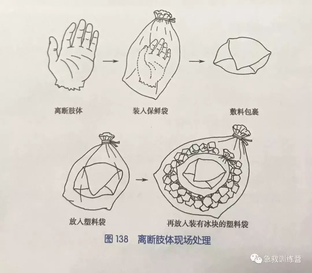 或布包裹(也可装入塑料袋中再包裹),将包裹好的断肢放入塑料袋中密封