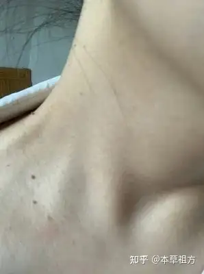脖子长丝状疣(小肉瘤子)会传染家里人吗? - 知乎