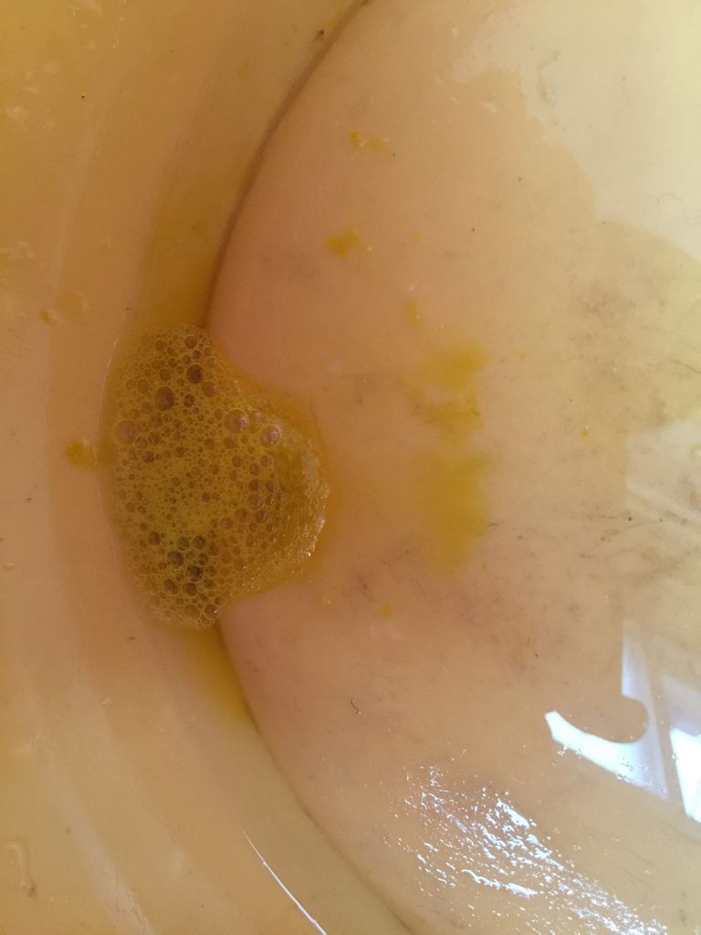 六个月宝宝拉稀,拉泡泡怎么回事?怎么办?