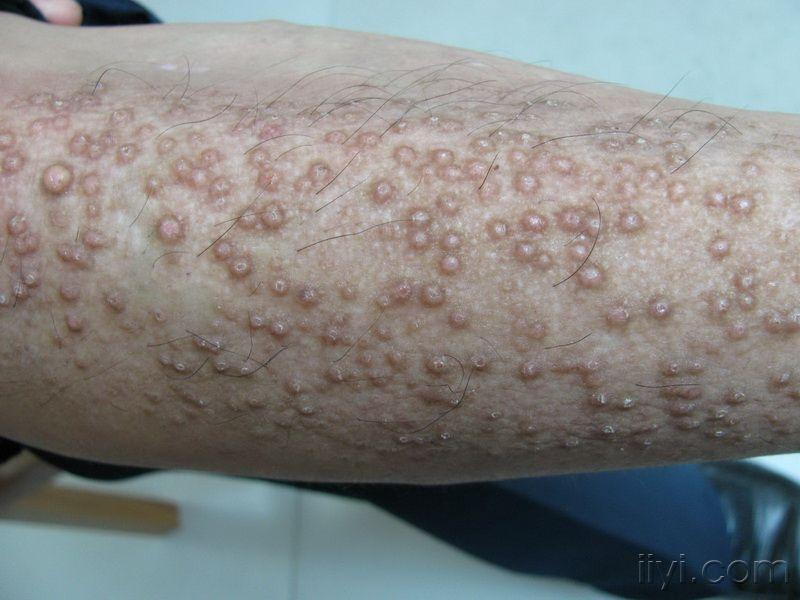 小腿皮疹皮肤淀粉样变