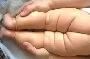 患儿臀纹或大腿皮纹不对称,一侧下肢外旋少动,行走较晚,伴跛行(俗称