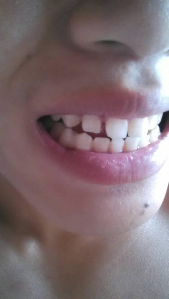 这样的牙缝能整吗,大概要多少钱,我已经19岁了,不知道工作以后能牙齿