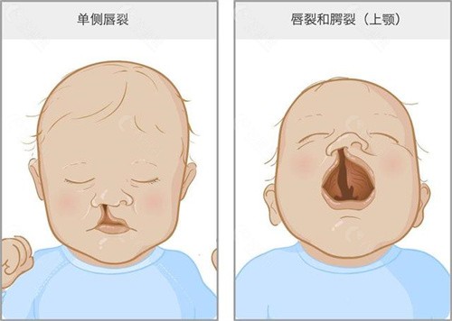 2022全国唇腭裂医院排名一览,含唇腭裂修复好的医生及价格