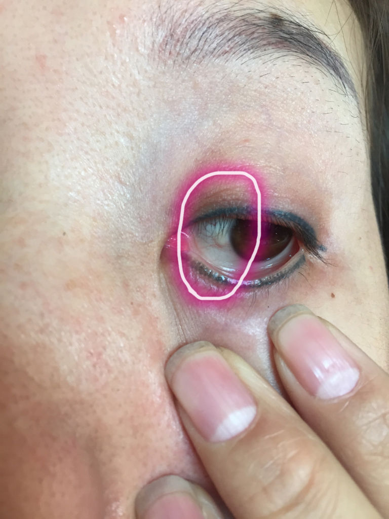 眼睛里白眼球上有个白色的小肉球,是怎么回事啊?