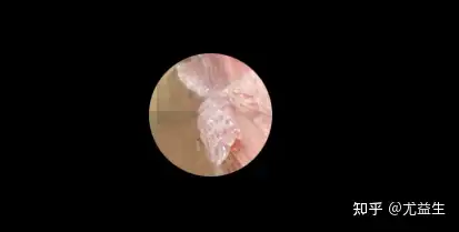 珍珠疹和尖锐湿疣图片区分