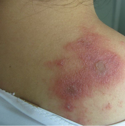 虫咬性皮炎图片 (109)_有来医生