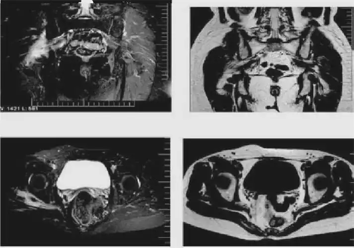 梨状肌综合征的解剖评估诊断及康复治疗