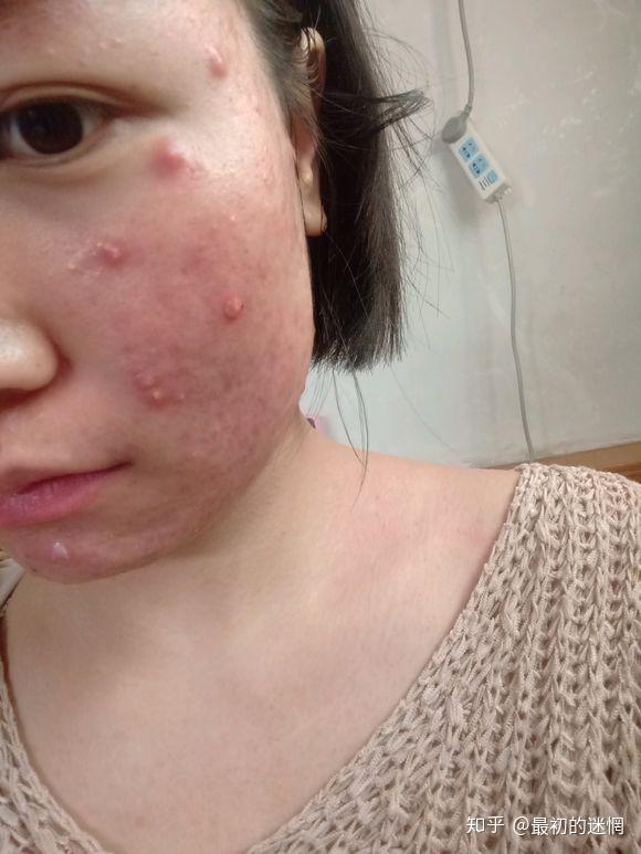 结节性痘痘怎么处理?