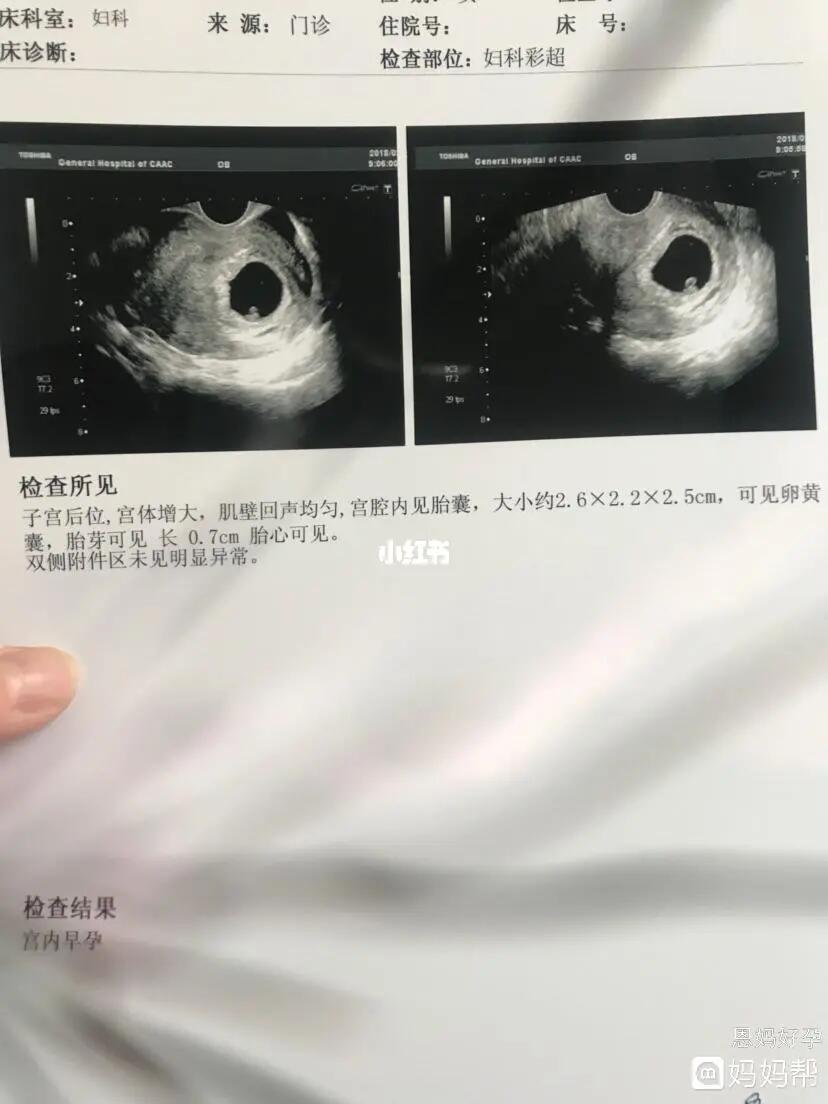 有一种说法认为,在怀孕9周之前通过b超看胎囊的形状可以判断出男女