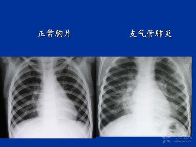 小儿肺炎的治疗