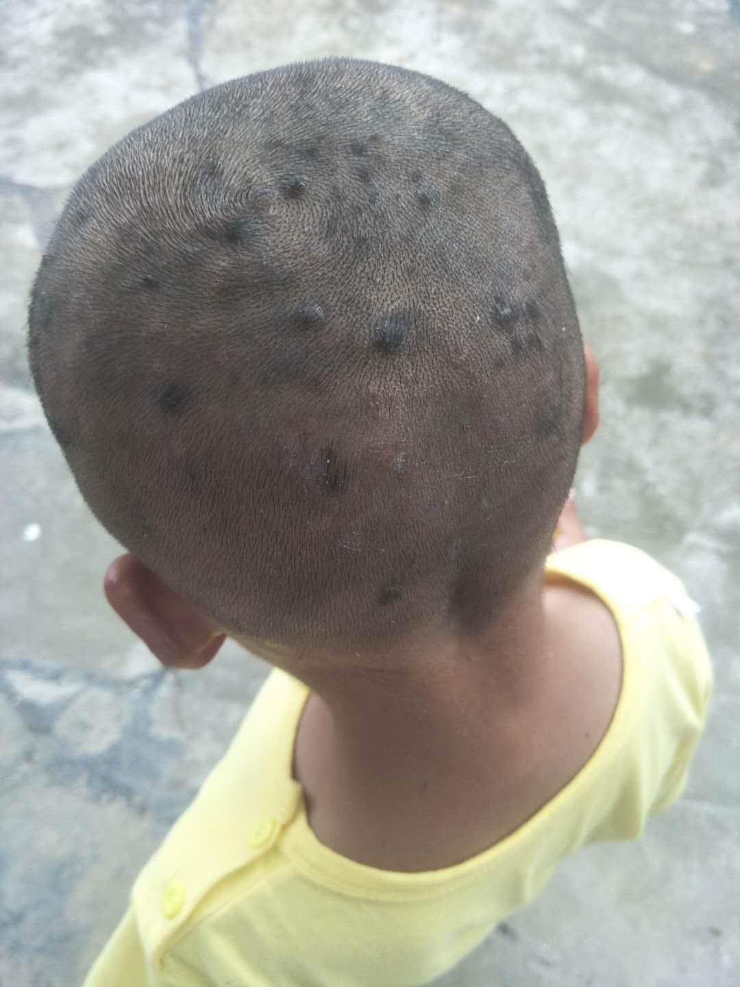小孩子头上长好多包,怎么治