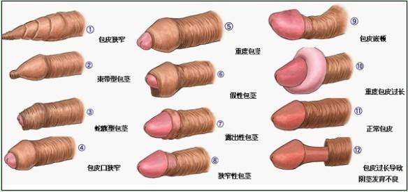 包茎麻醉方式是什么