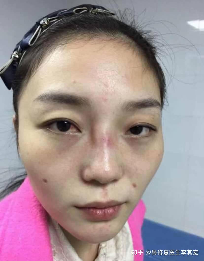 隆鼻手术毁容的恐怖你一定不敢点进来看