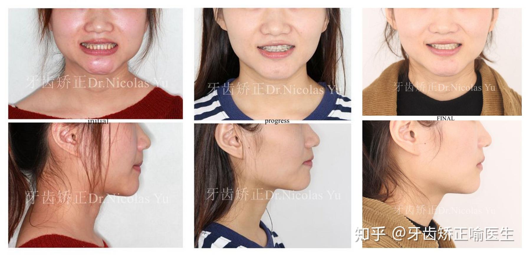 请问我这种是上颌发育不全吗? - 知乎