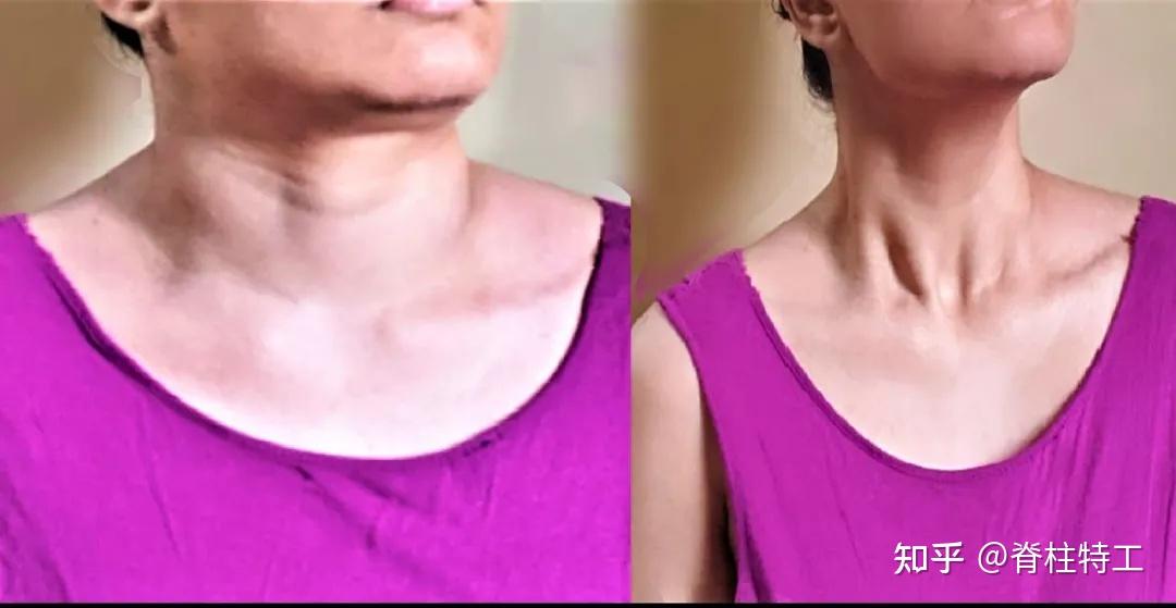 1,锁骨天生不直?