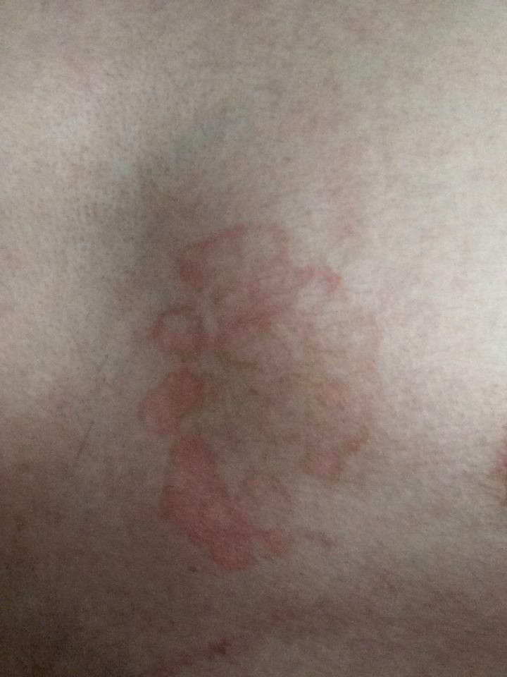胸前皮肤上有一块红斑(不是很明显),一年多了,不痒不痛.