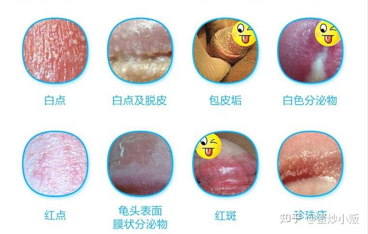 男性为什么会得龟头炎阿怎么搞的