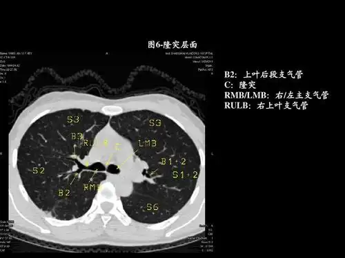 胸部ct的正常结构及肺部疾病的影像学表现ppt